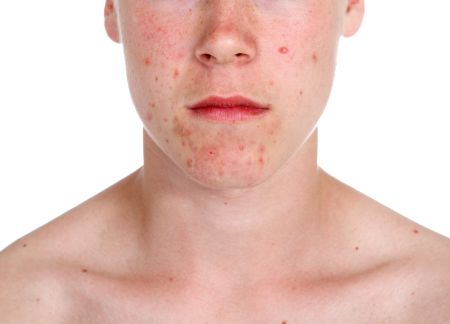 acneea cauzata de steroizi