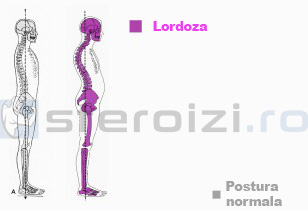 Pozitie lordoza